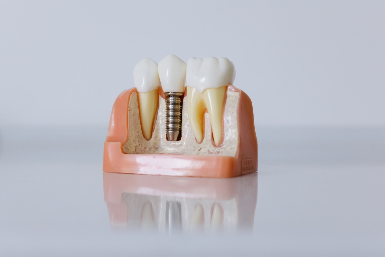 Jakie właściwości ma koronka na zęby?